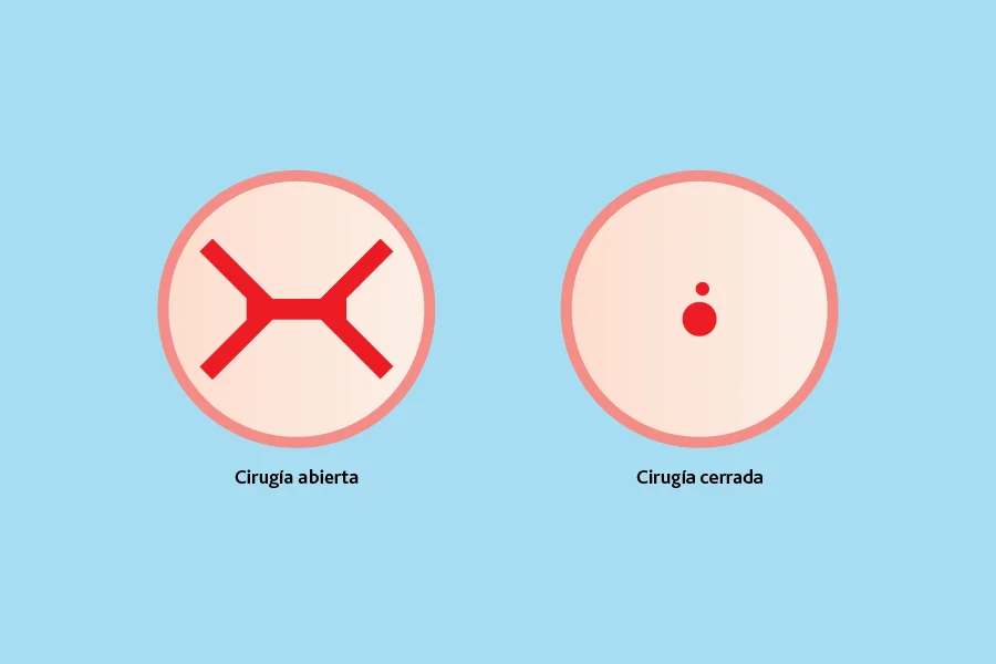 Cirugías Exostosis Subungueal Cirugías Exostosis Subungueal