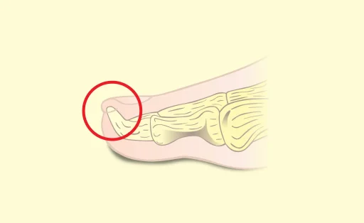 Exostosis Subungueal