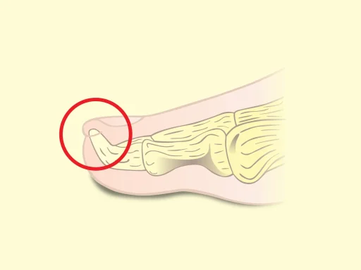 Exostosis Subungueal