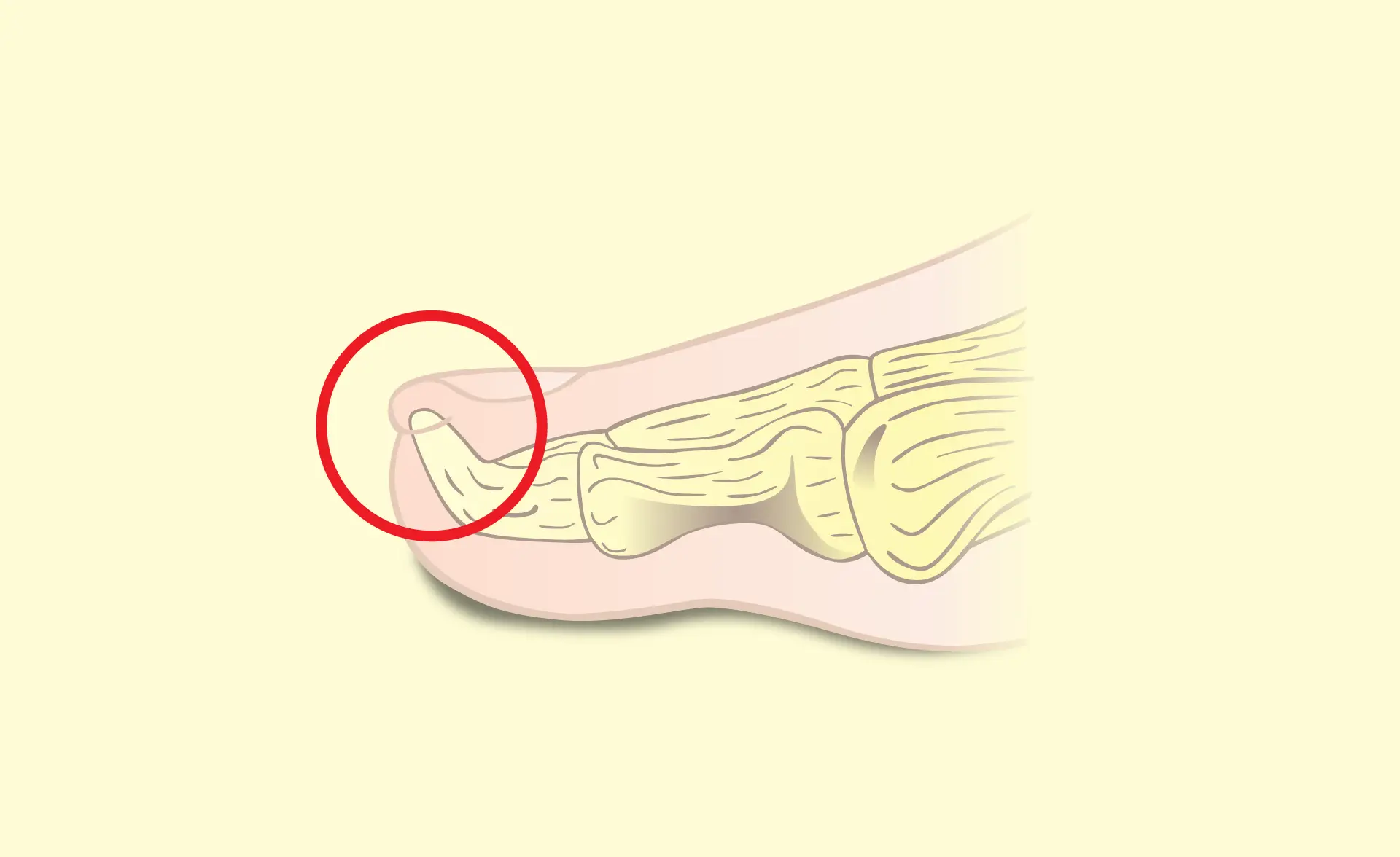 Exostosis Subungueal