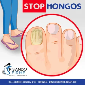 tratamiento onicomicosis con láser Torrevieja tratamiento onicomicosis con láser Torrevieja