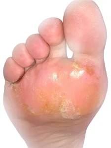 ¿Qué es la Dishidrosis plantar? ¿Qué es la Dishidrosis plantar?