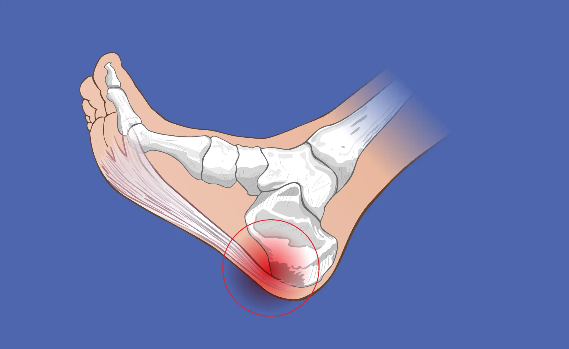 ¿Qué es la fascitis plantar?