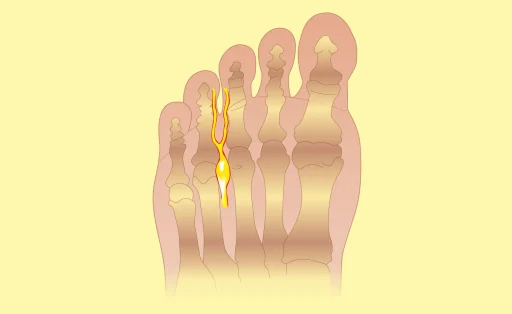 ¿Qué es el neuroma de morton?