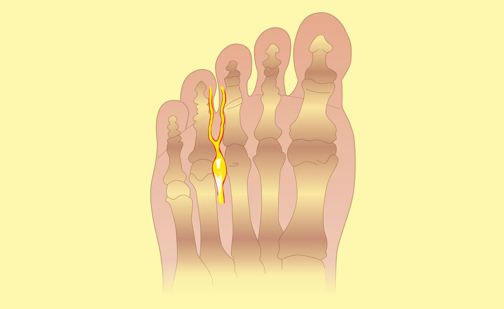 ¿Qué es el neuroma de morton?